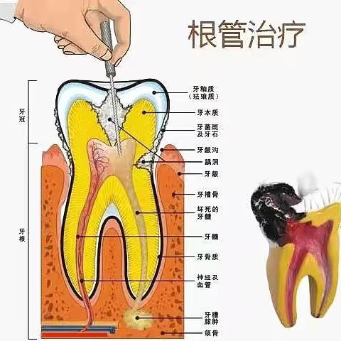 根管治疗：守护牙齿健康的必要措施