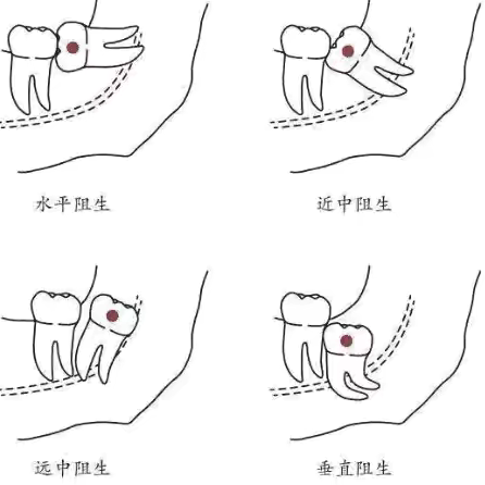 智齿拔除：全面指南