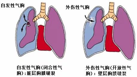 普外科患教会——气胸患者的护理