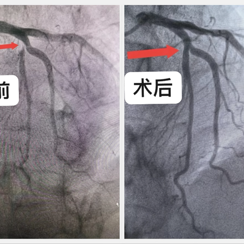 一例"治愈”的严重冠心病