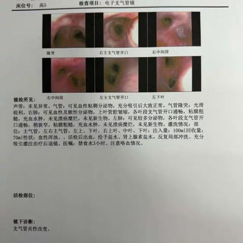 支气管镜灌洗解决大难题