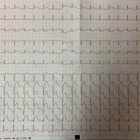 与死神争分夺秒，唯有东方速度-记心内科一例急诊手术