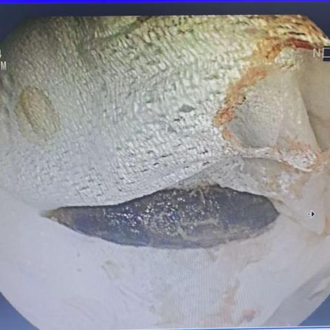 消化三病区成功完成一例高龄患者食管异物取出术