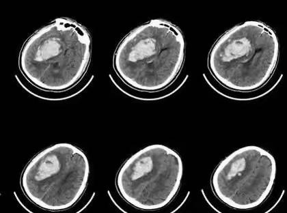 脑出血的预防体会
