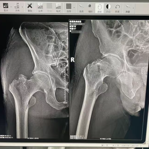 案例分享-股骨转子间粉碎性骨折 -钢板内固定术