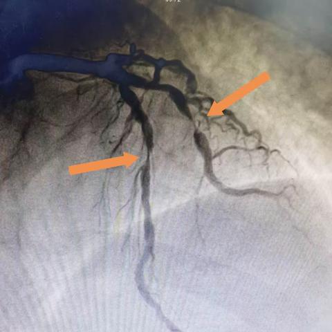 生死时速--急诊PCI为急性心肌梗死患者开启绿色通道