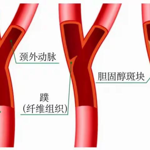 突发脑卒中，竟是血管里长“蹼”