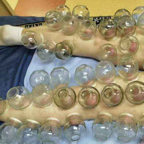 燃脂罐医学：传统中医拔罐在减肥调理中的应用