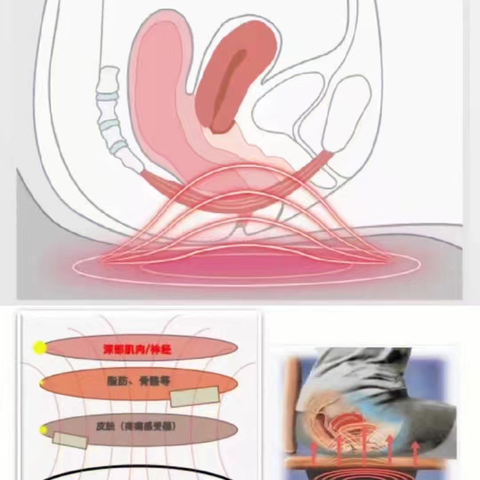 关于盆底肌治疗您知多少？