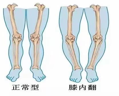 常见膝内翻的康复训练及方法
