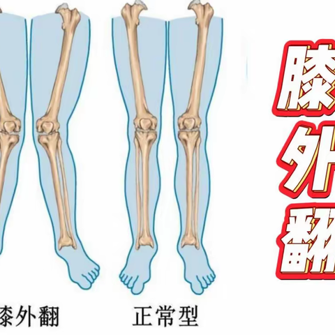 膝外翻训练