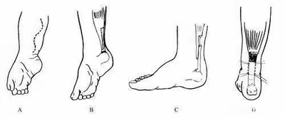 马蹄内翻足训练