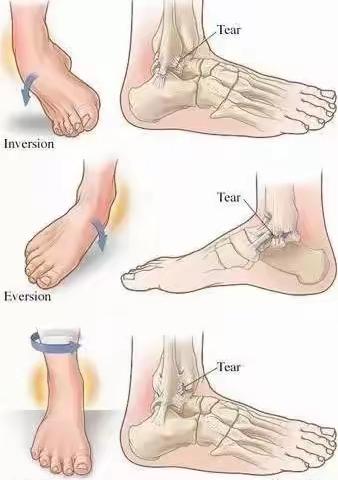 脚踝扭伤康复健康教育