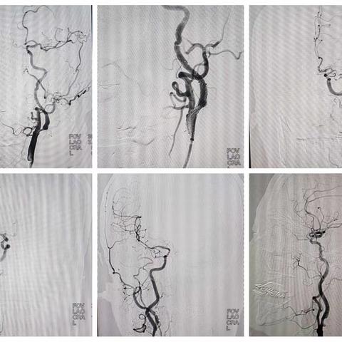 脑病中心全脑血管造影术不断发展