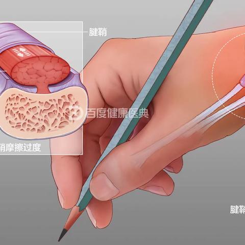 腱鞘炎