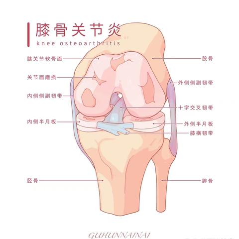 膝关节骨性关节炎