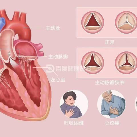 主动脉瓣狭窄