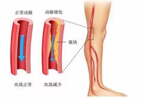 省二院新技术-糖尿病合并下肢动脉病变筛查