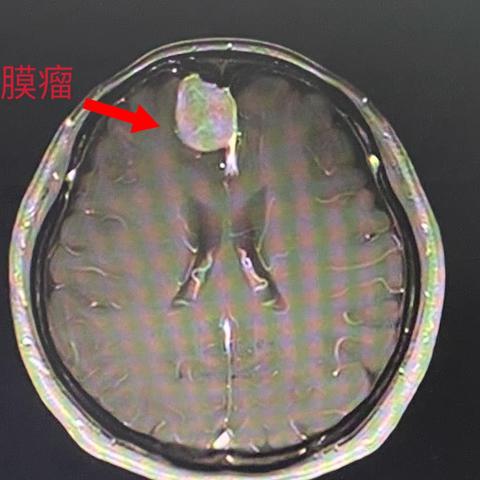 西安市第九医院神经外科完成高难度脑膜瘤手术