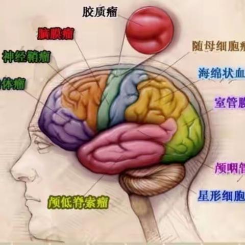 脑科医生揭秘及早发现脑肿瘤的神器:体检做头部CT！