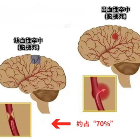 脑卒中科普小知识，您都懂了吗？