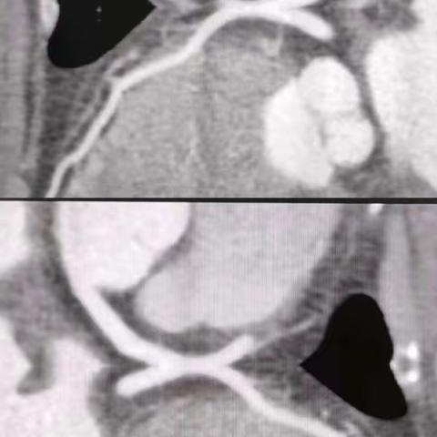 “励精图治”—影像科CCTA 心肌桥病例分享