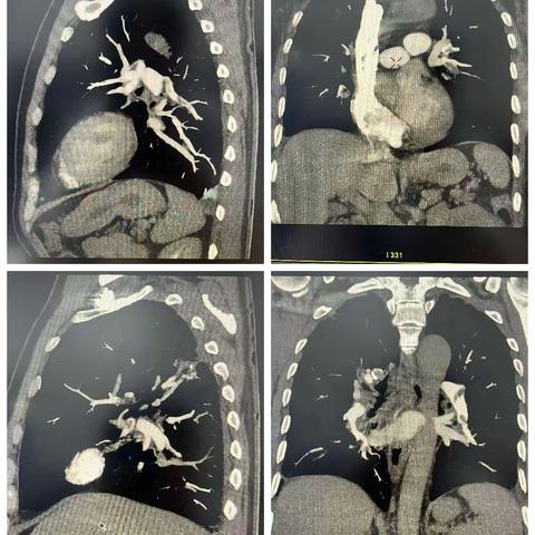 影像科64排螺旋CT，诊断肺动脉栓塞一例。