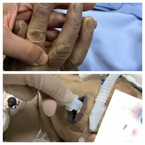 争分夺秒｜一例急性亚硝酸盐中毒患者成功救治