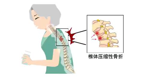 经皮椎体成形术科普（一）