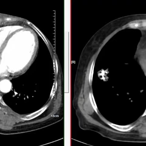 宜春市人民医院核医学科与呼吸科学术沙龙——粒子植入术和锶89治疗