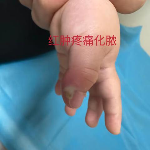 皮肤日常护理：肉刺