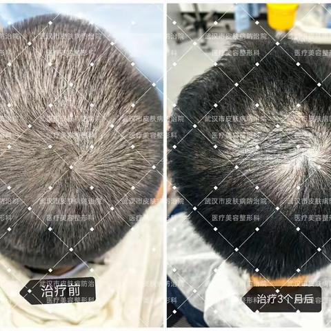 浪漫七夕，别让头皮“秃”然而至