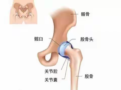 前沿技术——兰考第一医院完成院内首例髋关节翻修术