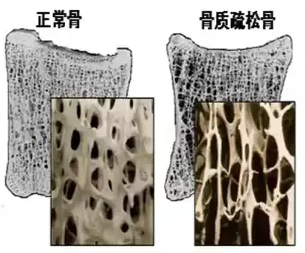 好消息—骨质疏松义诊活动通知