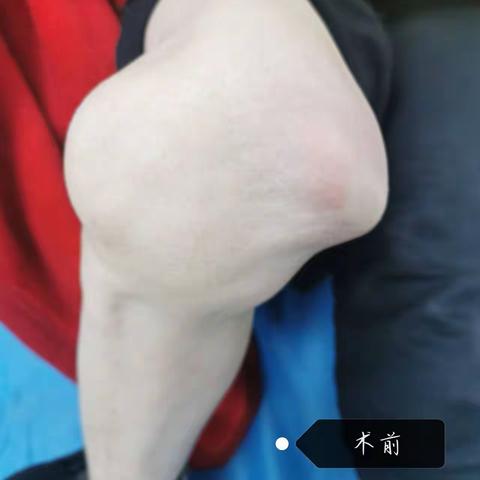 微创无止境—膝关节镜下交叉韧带重建术