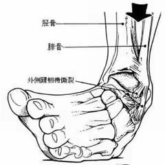 踝部骨折健康教育