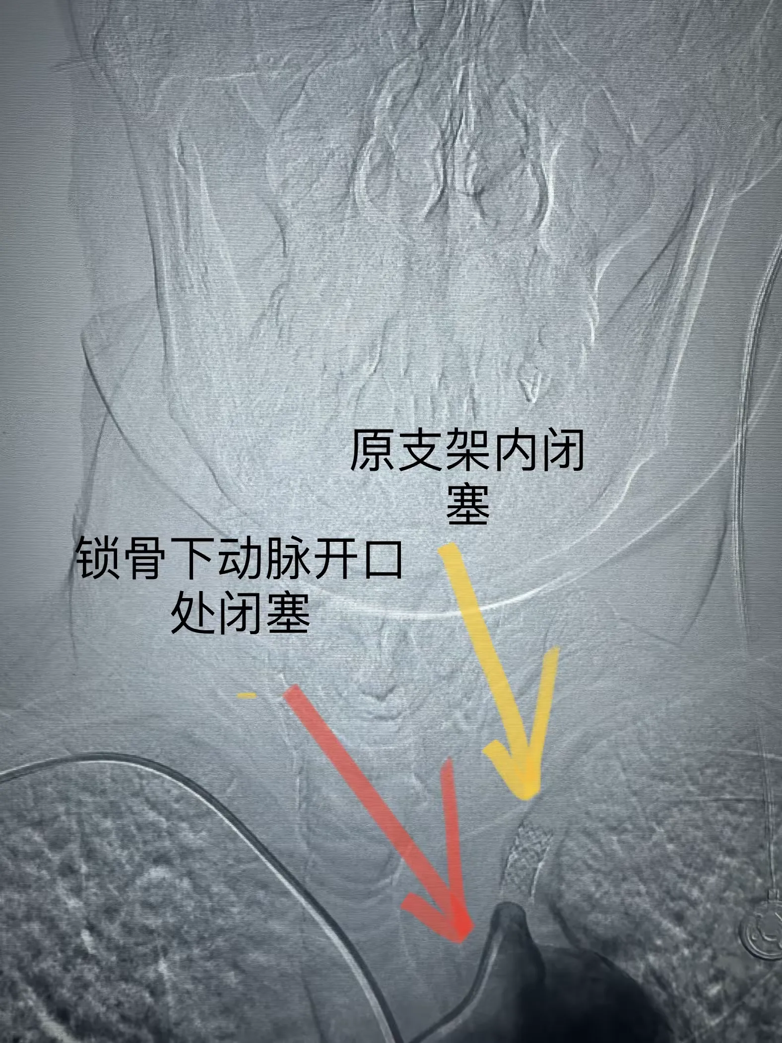 简篇-铜川矿务局中心医院神经内科成功开展首例锁骨下动脉支架内闭塞开通手术。