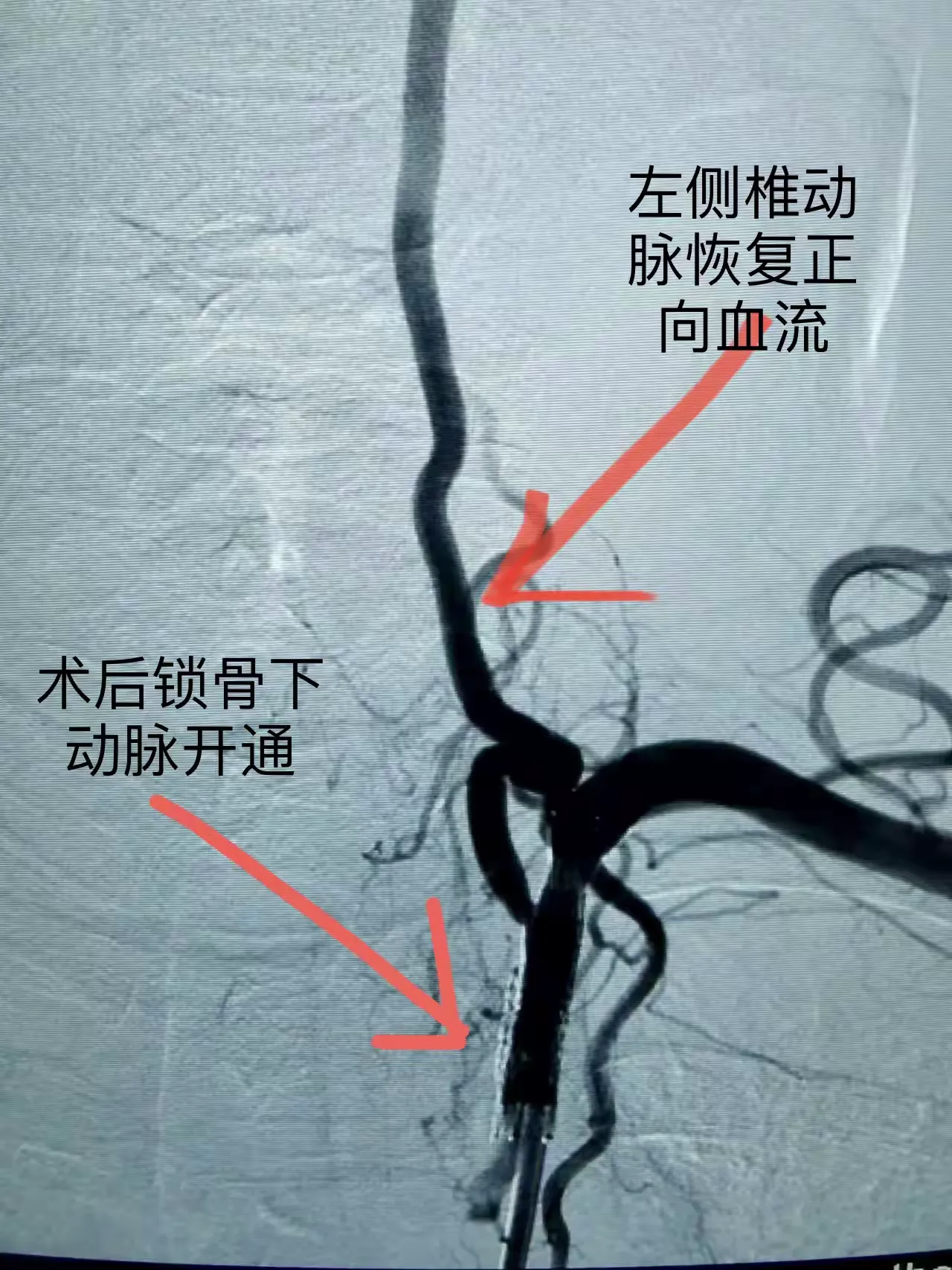 简篇-铜川矿务局中心医院神经内科成功开展首例锁骨下动脉支架内闭塞开通手术。