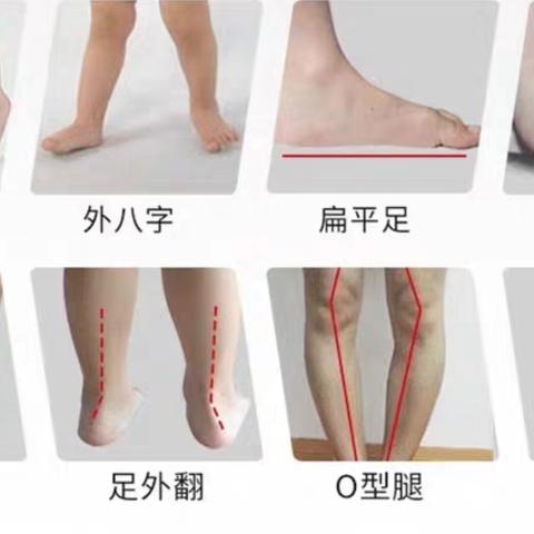 什么是X型腿、O型腿?