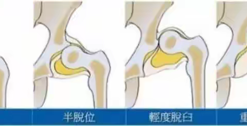 小儿髋关节发育不良