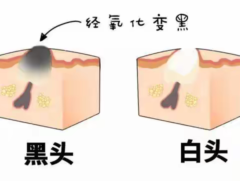 日常如何预防产生黑头？（副本）