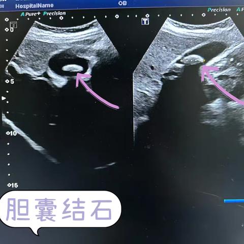 疯狂的石头—《胆结石》