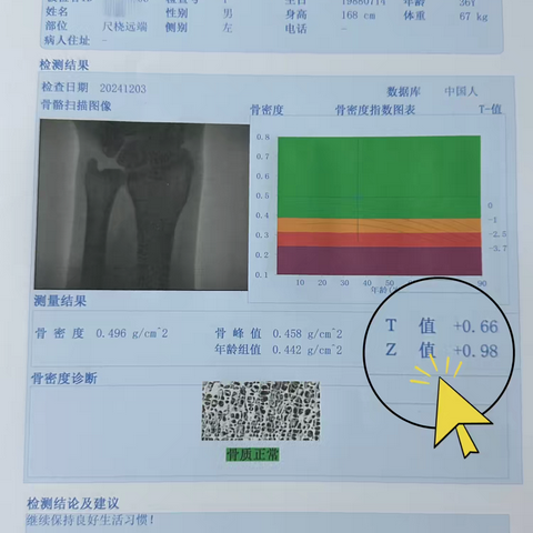 骨密度报告怎么看❓