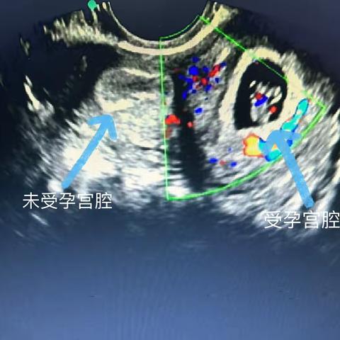 超声小科普——双子宫