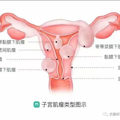 不死的癌症-子宫肌瘤，微创介入诊疗“饿死”肌瘤，打响子宫保卫战！