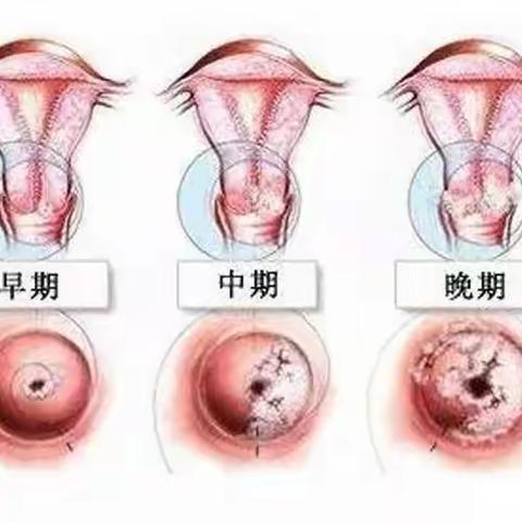 宫颈炎症知多少？