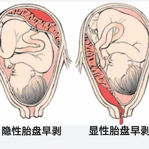 弥勒第一医院与虹溪卫生院 市乡两级联动成功抢救危重孕产妇