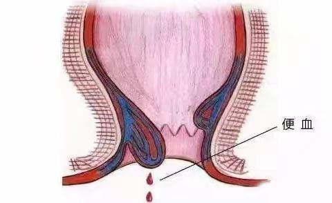 【守护"菊"部健康，远离难言之隐】——内乡县中医院肛肠科专业护航，让健康"肠"通无阻！