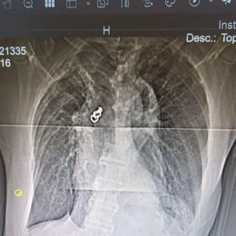 寻牙记——雄安新区容城县人民医院内一科联合内镜室麻醉科共同完成一例支气管镜下异物取出术