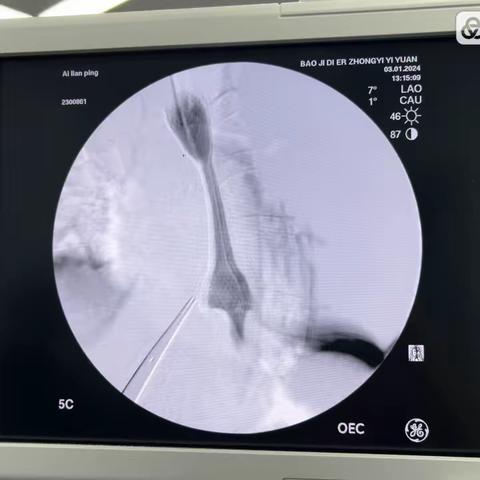 食道狭窄进食难，支架植入解难题！